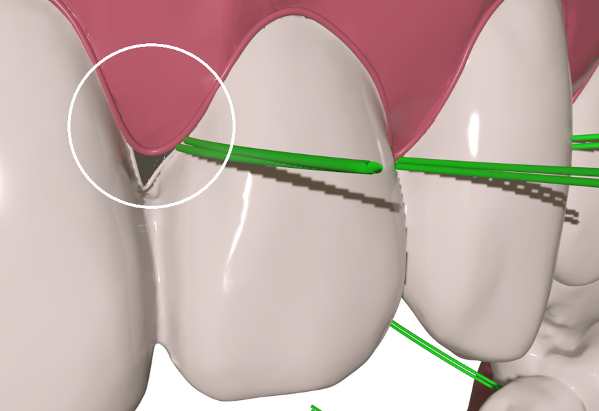 "Can the Blizzflosser clean papillae and subgingival surfaces too?"